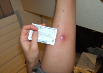 tea tree oil for skin infection