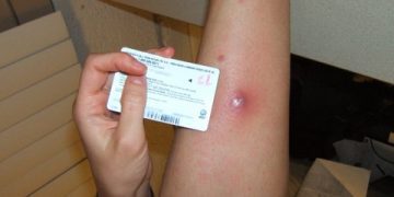 tea tree oil for skin infection