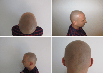 Seborrheic dermatitis