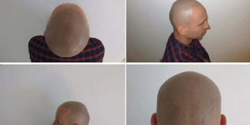 Seborrheic dermatitis