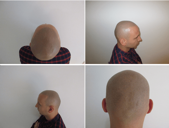 Seborrheic dermatitis
