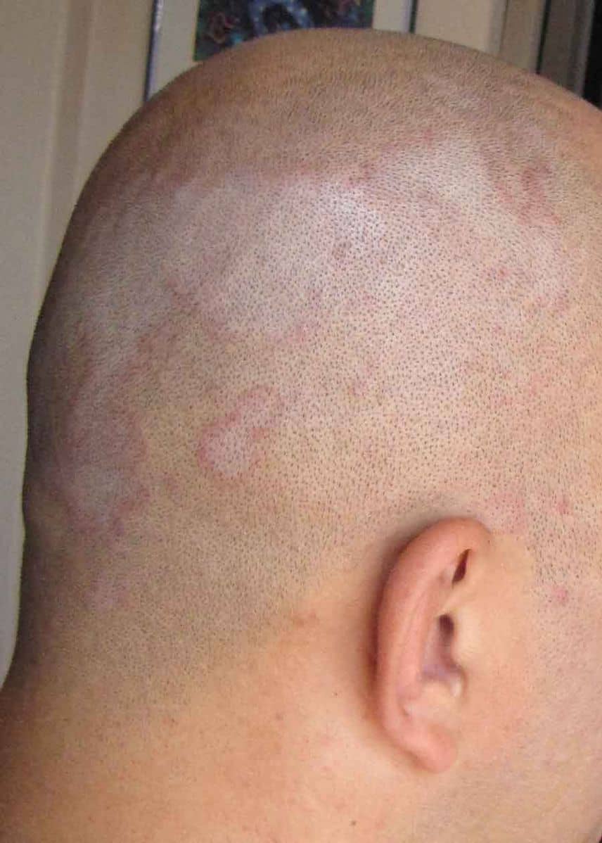 Seborrheic dermatitis