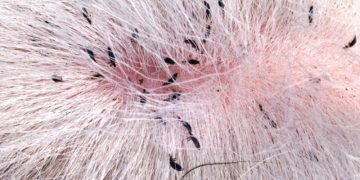 tea tree oil for scalp