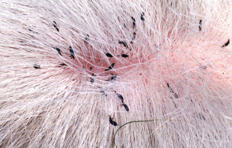 tea tree oil for scalp