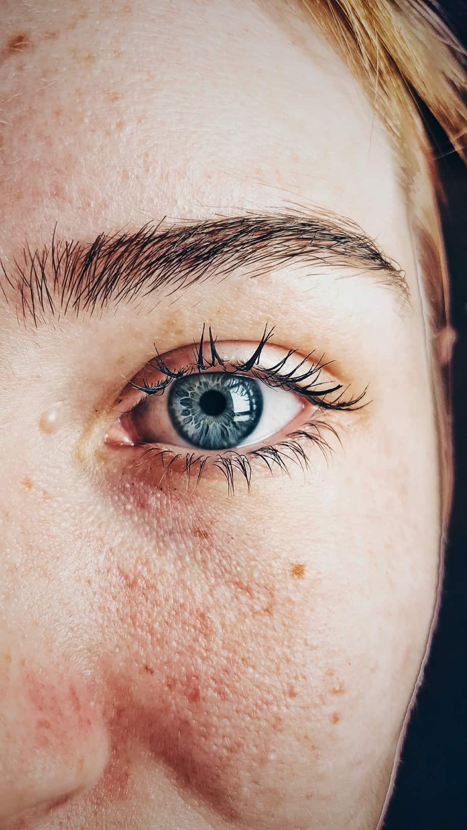 Using Tea tree oil for pimples